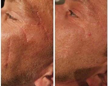 Kouterclinic littekencorrectie